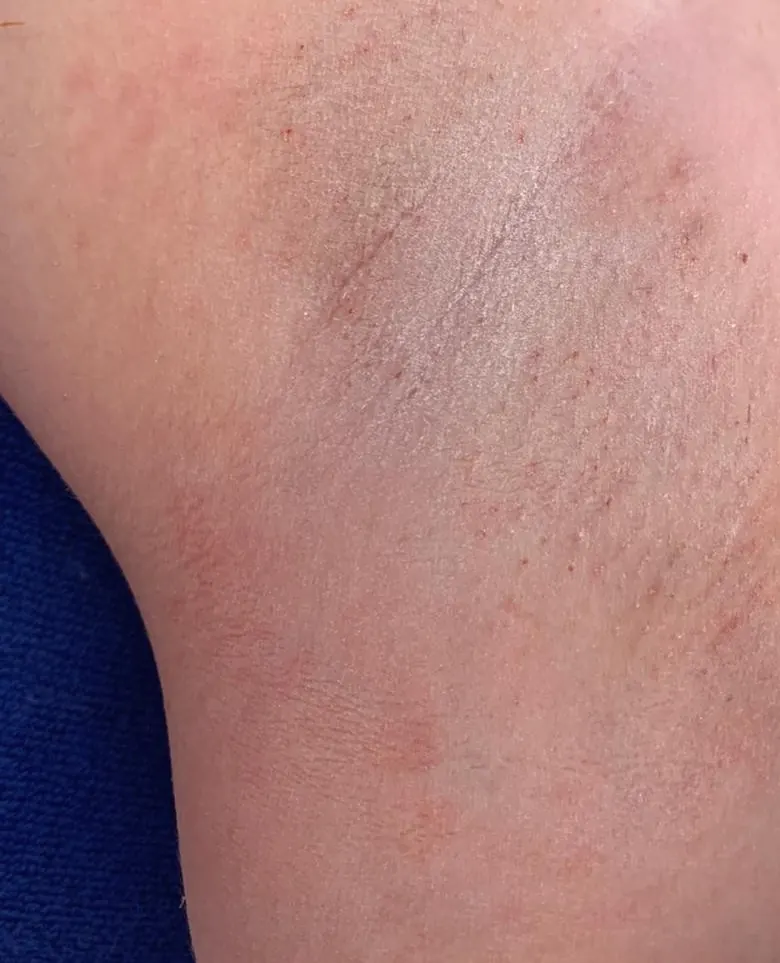 Close-up of skin after a careful waxing