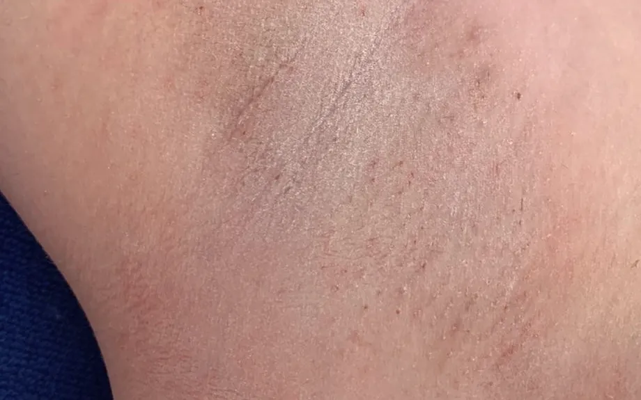 Close-up of smooth skin just after a waxing treatment
